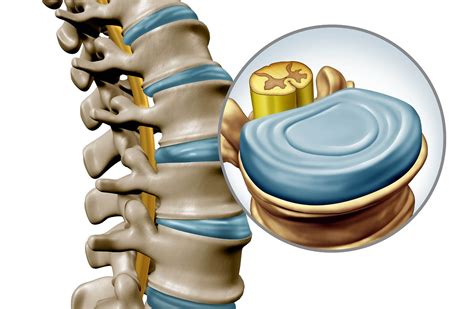 Većina povreda zadobijenih tokom mrtvog dizanja su nespecifične povrede donjeg dijela leđa, što znači da su obično uganuća ili istegnuća. . Operacija diskus hernije l4 l5